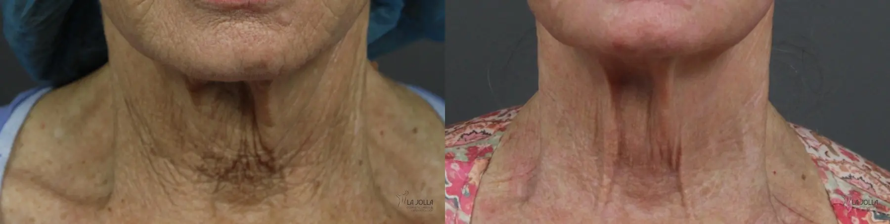 Ablative Laser Treatment: Patient 2 - Before and After 4