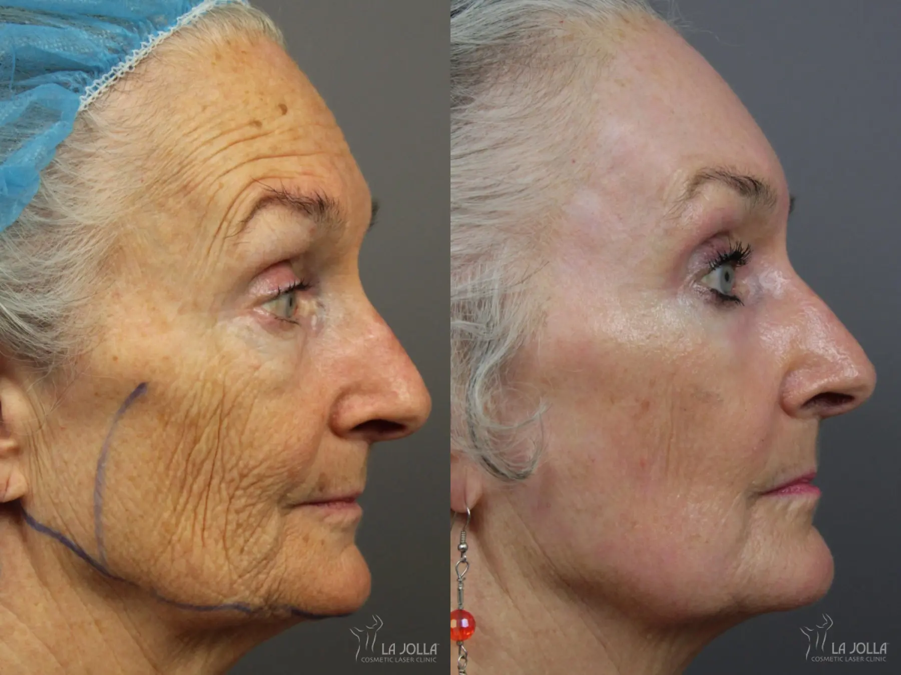 CO2 Laser: Patient 10 - Before and After 5
