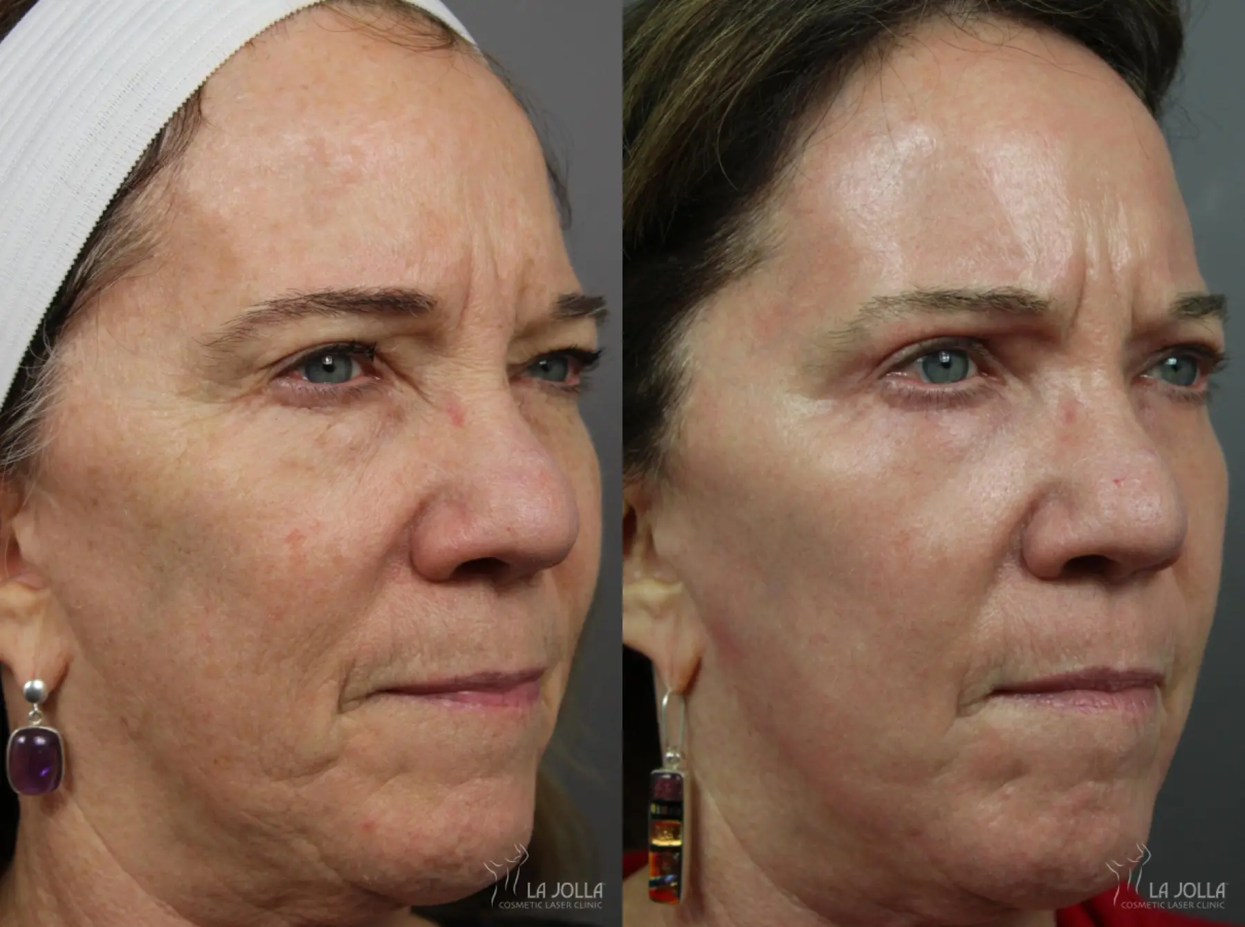 CO2 Laser: Patient 2 - Before and After 3
