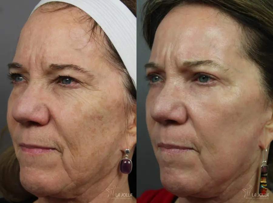 CO2 Laser: Patient 2 - Before and After  