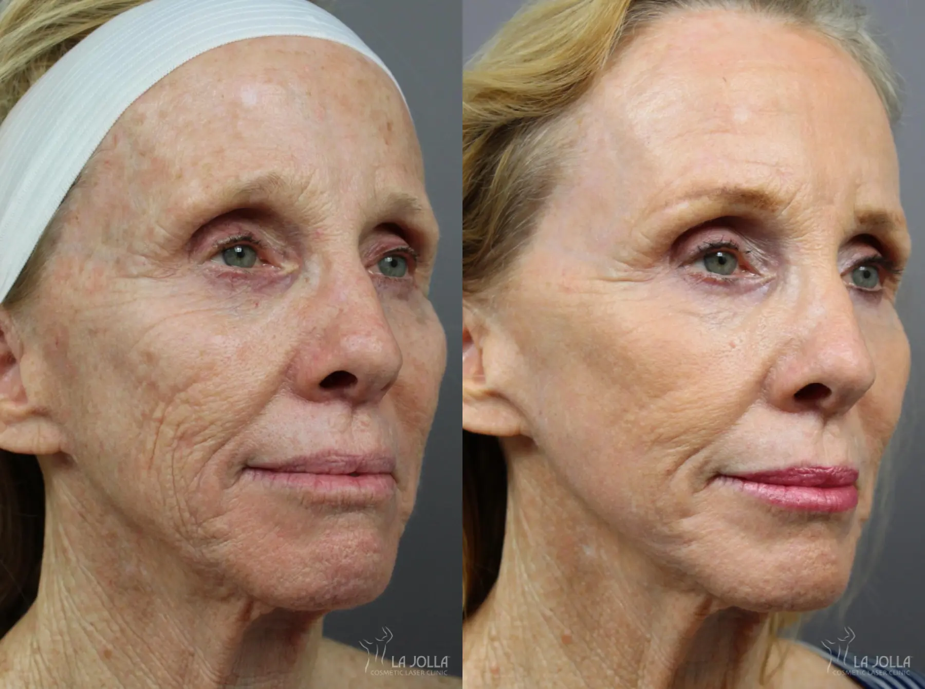 CO2 Laser: Patient 9 - Before and After 1