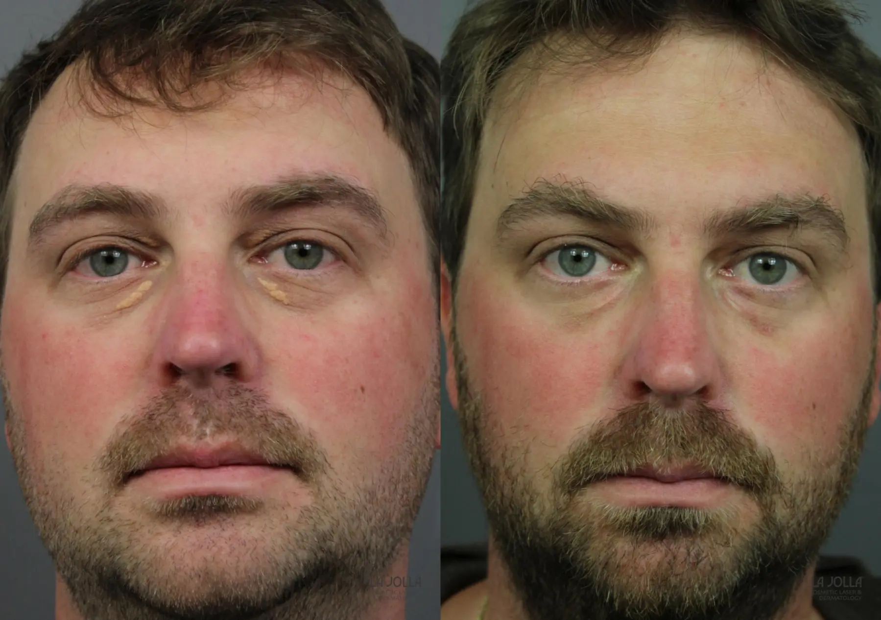 CO2 Laser: Patient 3 - Before and After 1