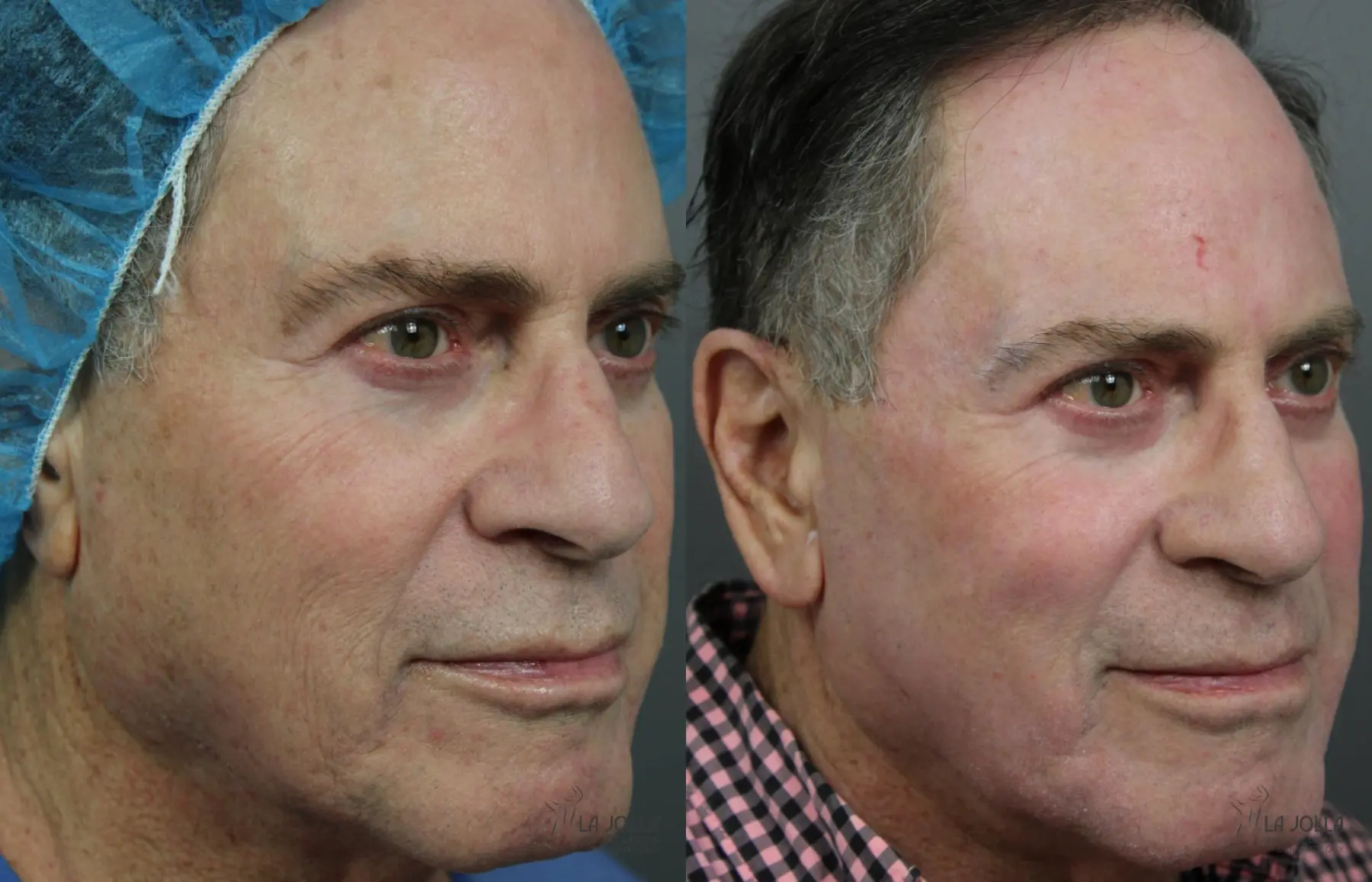 CO2 Laser: Patient 2 - Before and After 2