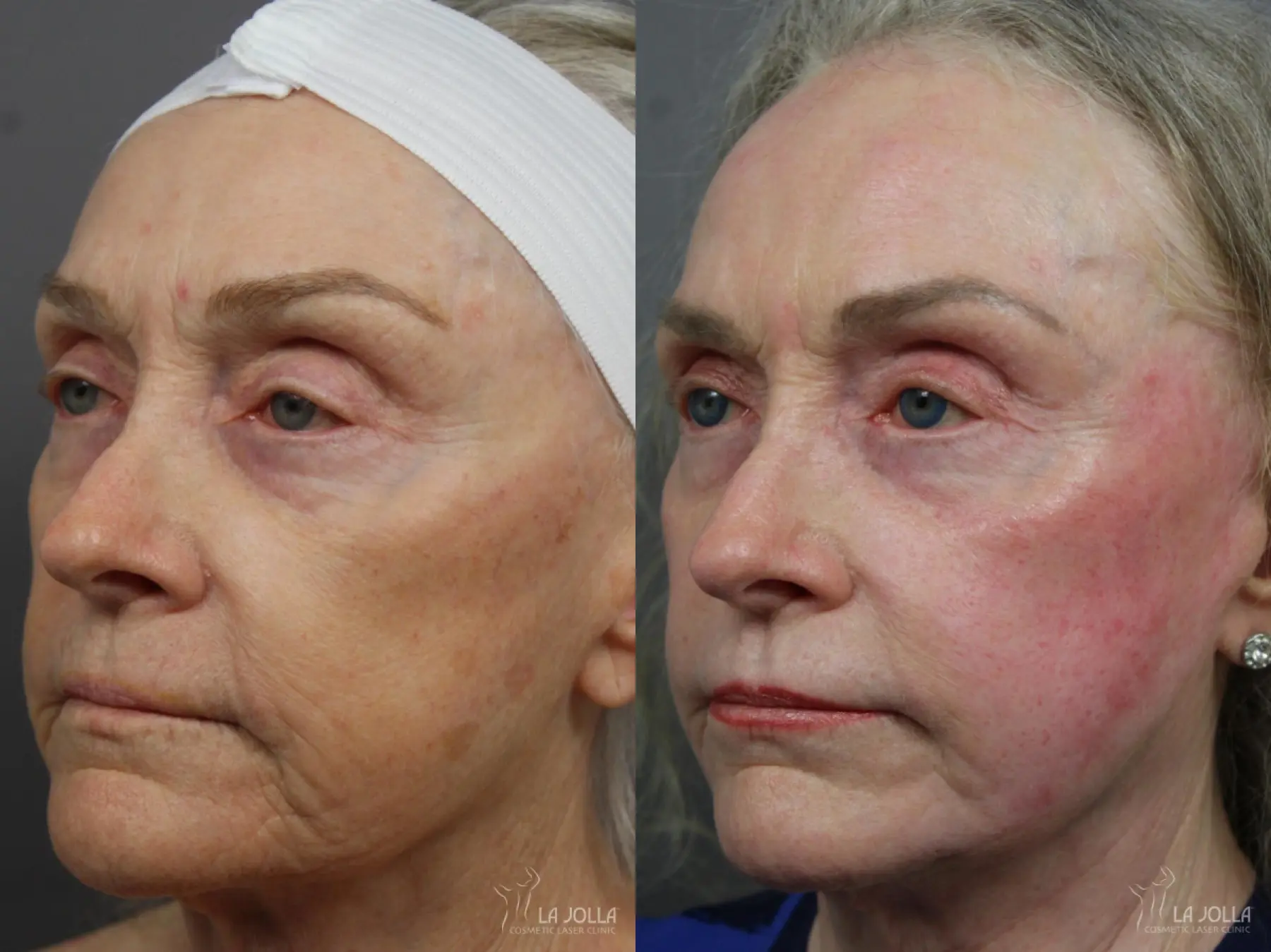CO2 Laser: Patient 6 - Before and After 2