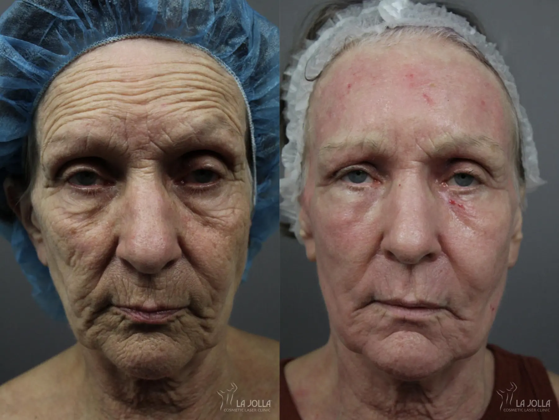 CO2 Laser: Patient 6 - Before and After  