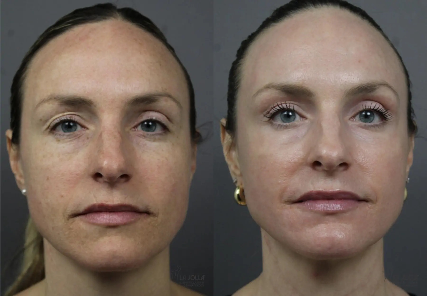 CO2 Laser: Patient 5 - Before and After  