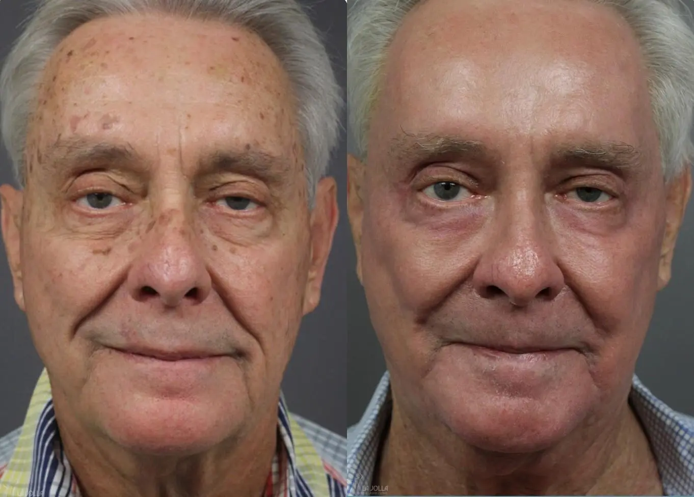 CO2 Laser: Patient 3 - Before and After  