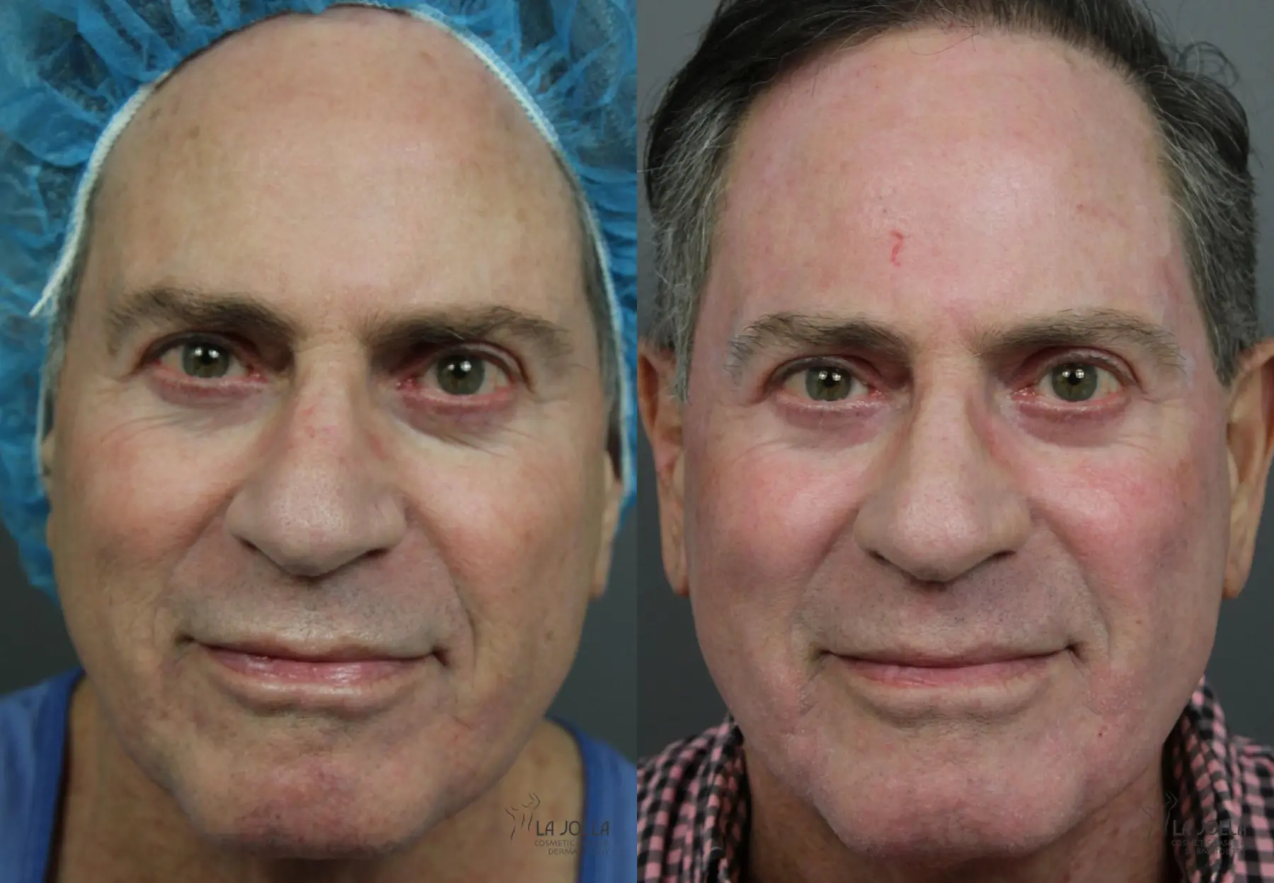 CO2 Laser: Patient 2 - Before and After 1
