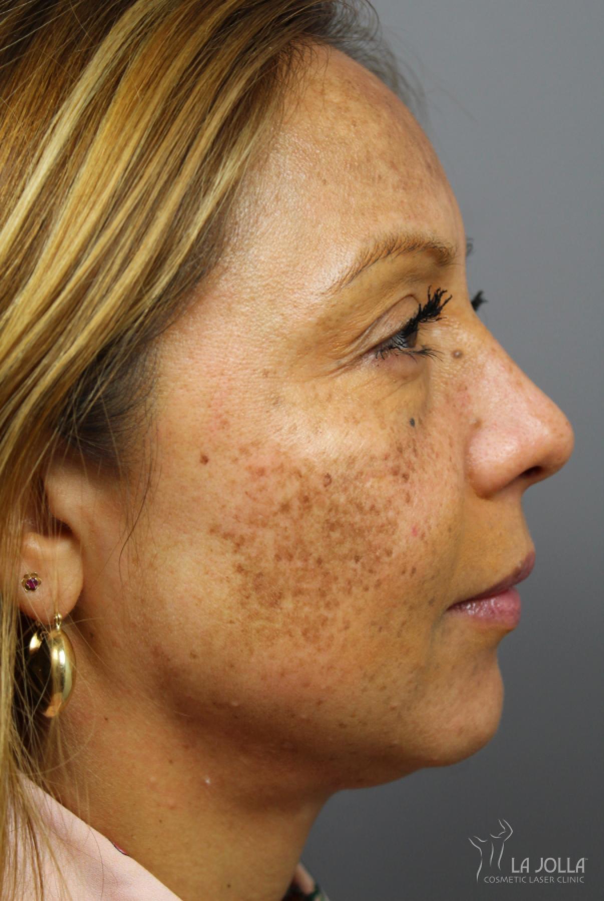 Skin Care Products: Patient 1 - Before 