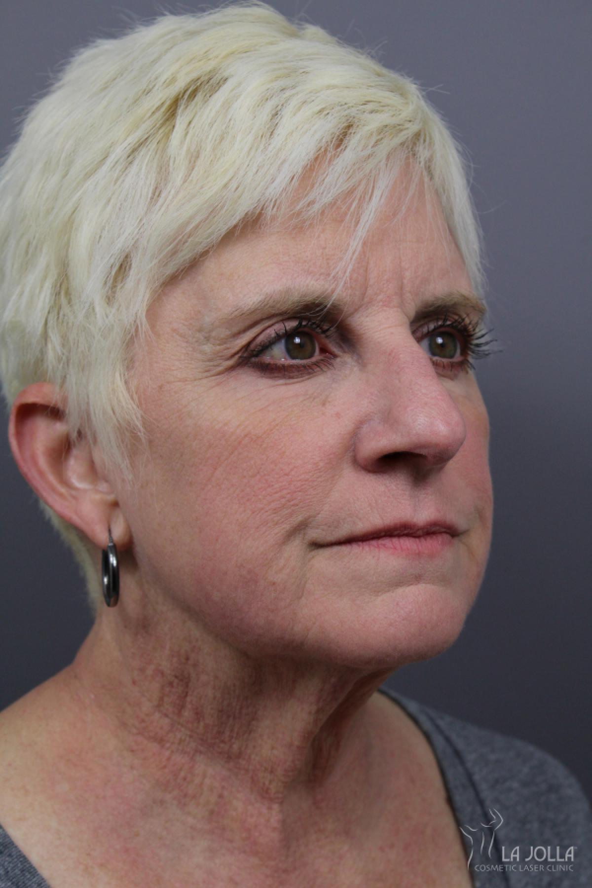 Poke A Dot Lift Patient 2 After Procedure
