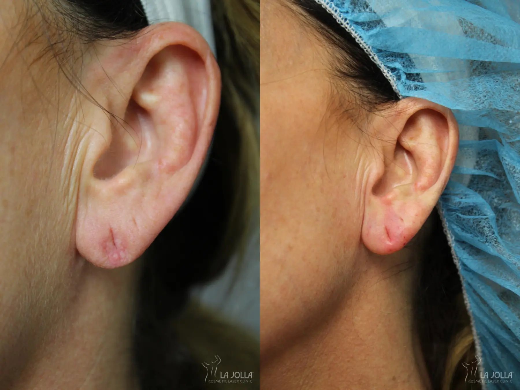 Dermal Filler: Patient 1 - Before and After  