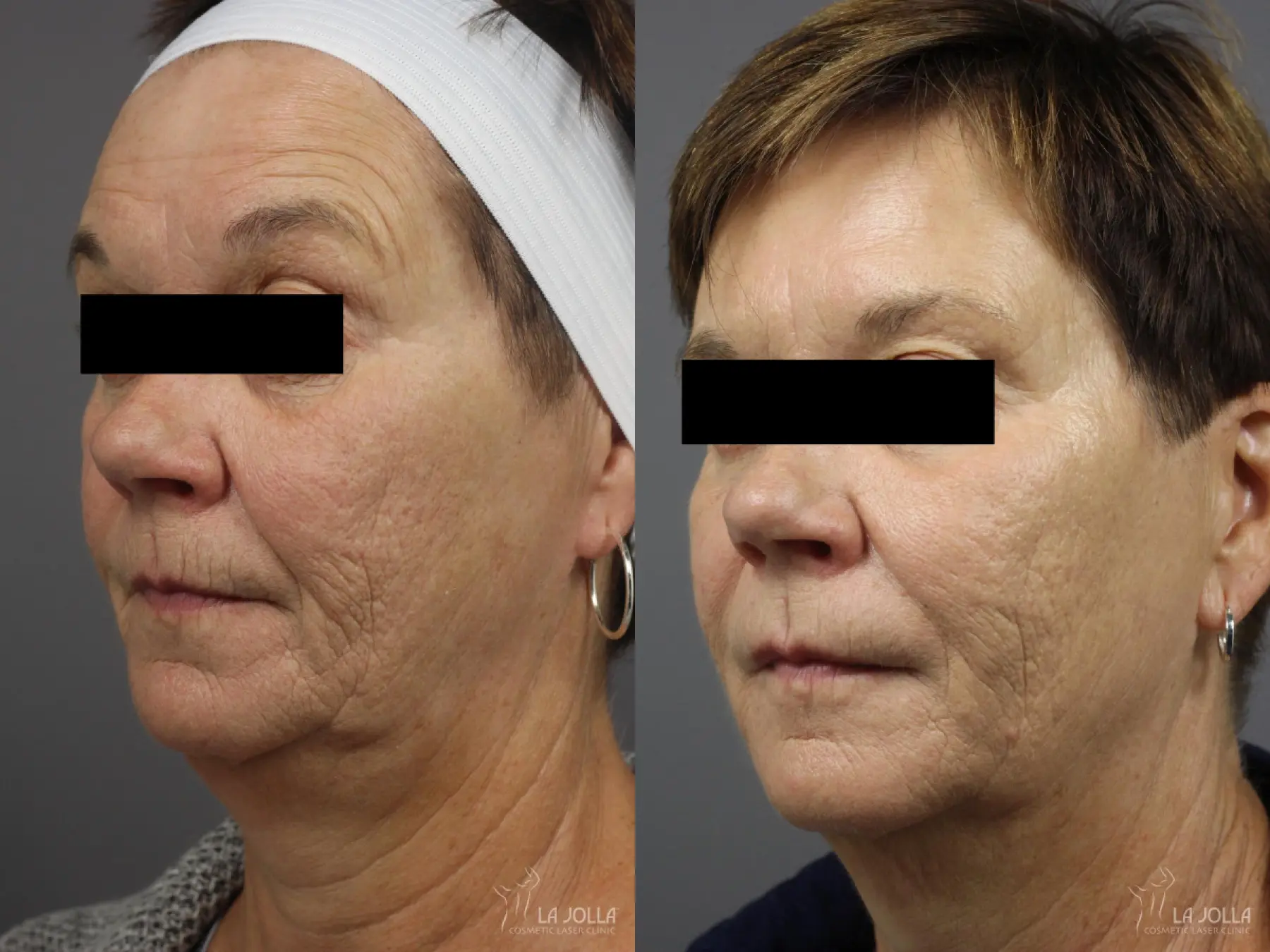 Dermal Filler: Patient 2 - Before and After  