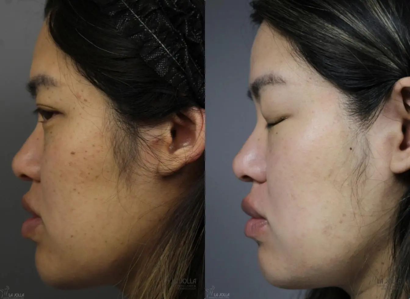 Dermatosis Papulosa Nigra (DPN): Patient 2 - Before and After 3