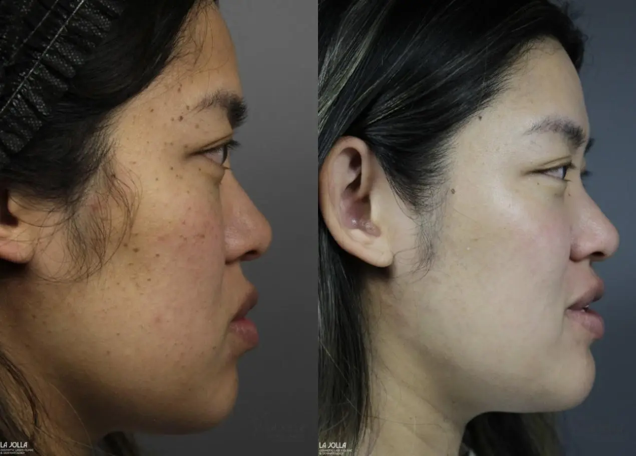 Dermatosis Papulosa Nigra (DPN): Patient 2 - Before and After 5
