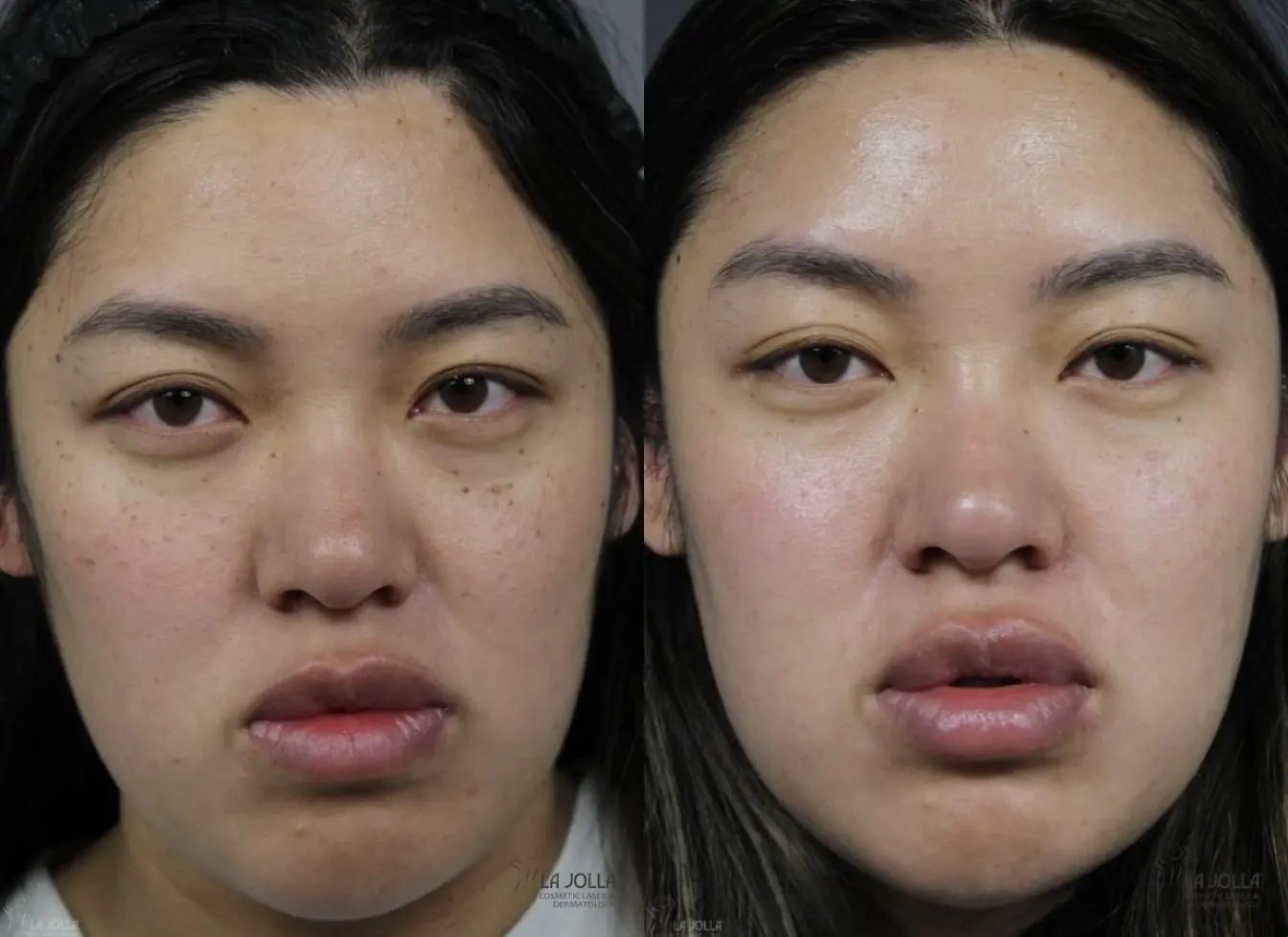 Dermatosis Papulosa Nigra (DPN): Patient 2 - Before and After  