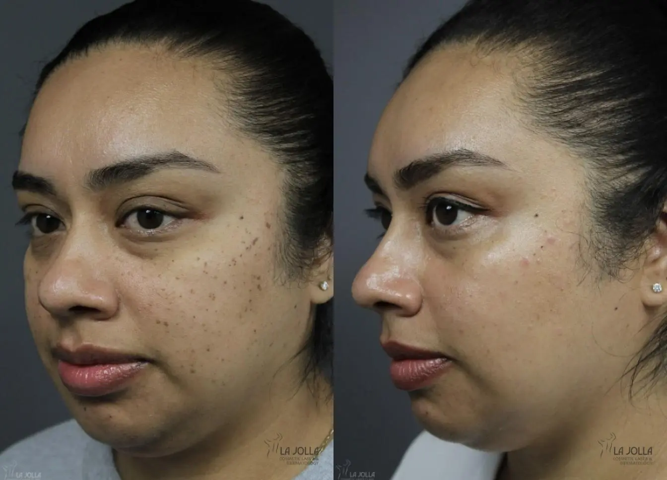 Dermatosis Papulosa Nigra (DPN): Patient 1 - Before and After 2