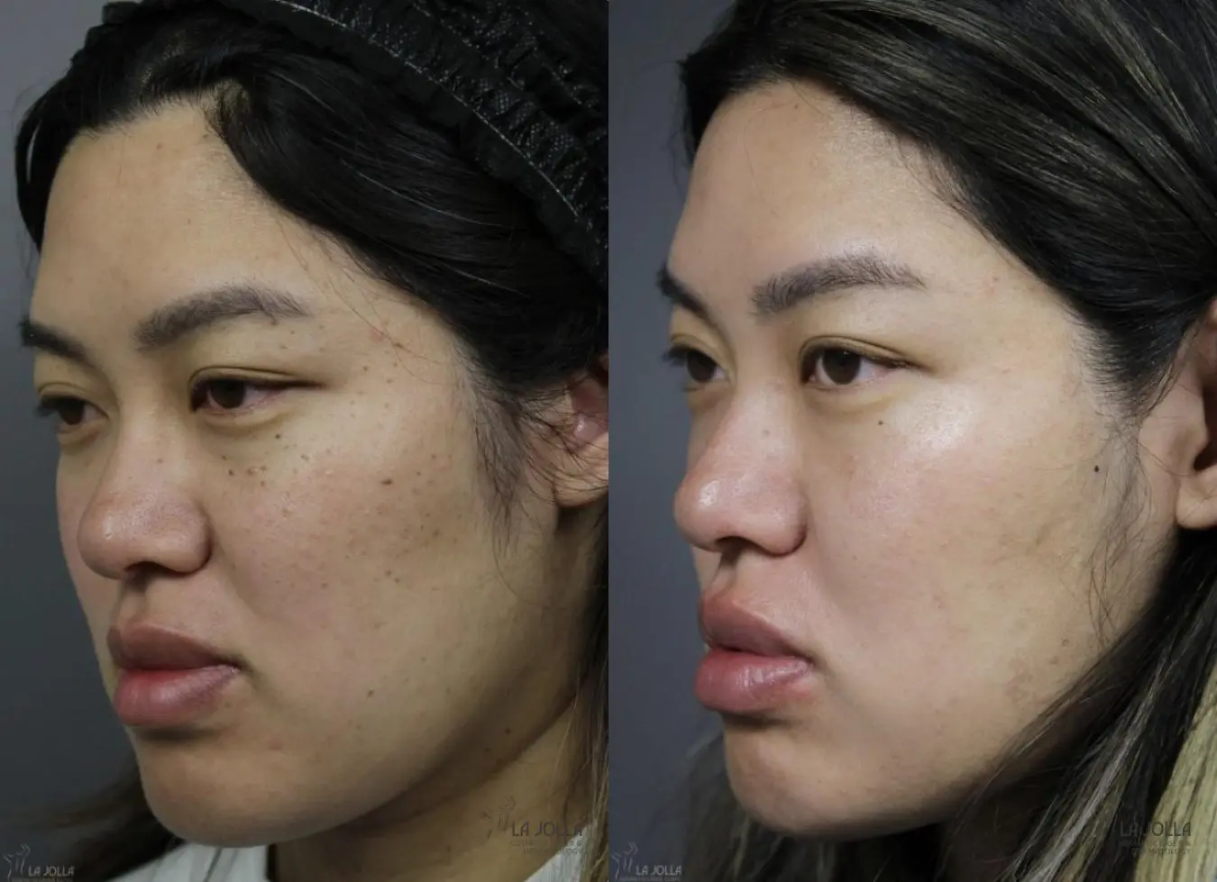 Dermatosis Papulosa Nigra (DPN): Patient 2 - Before and After 2