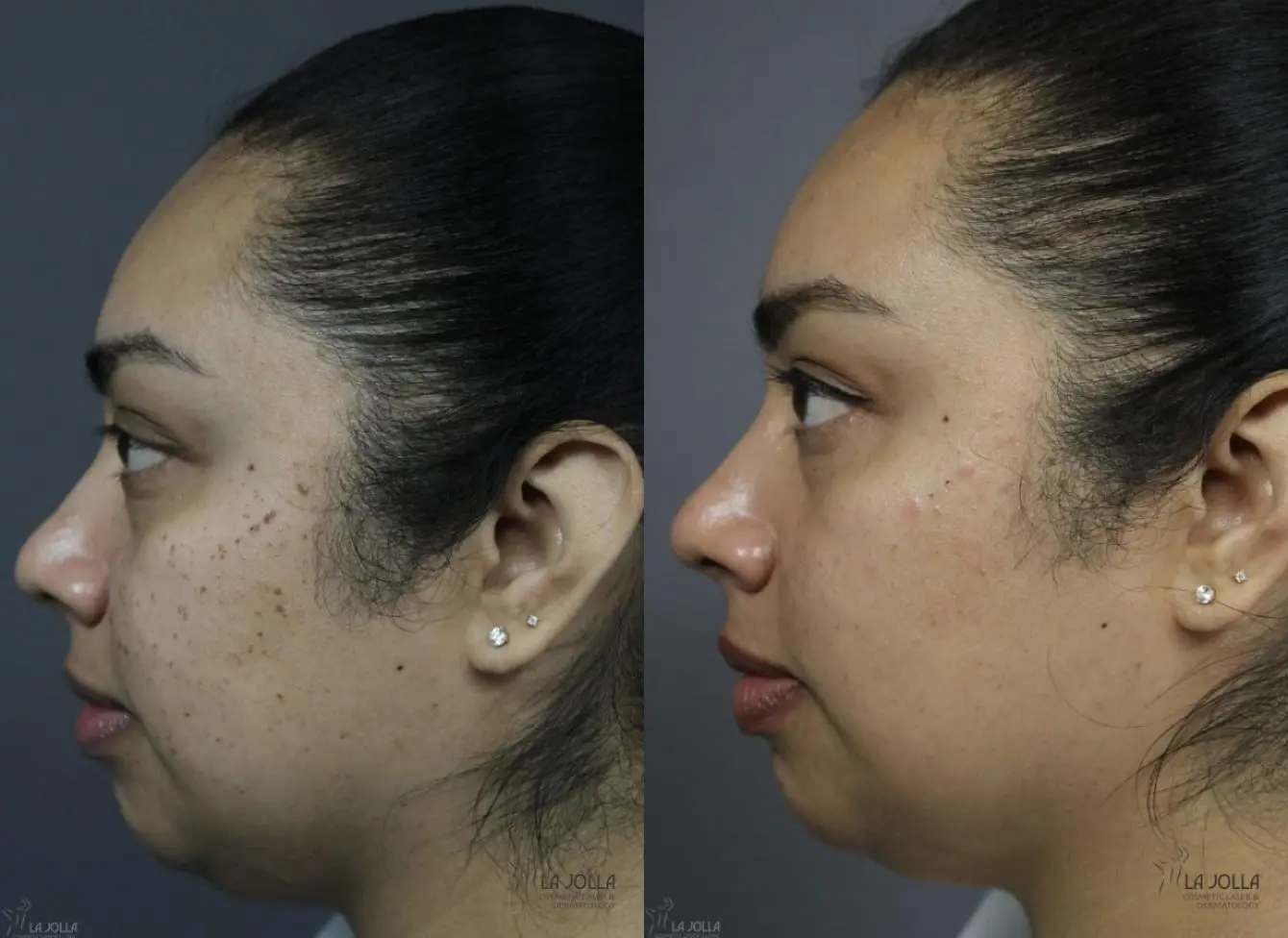 Dermatosis Papulosa Nigra (DPN): Patient 1 - Before and After 4