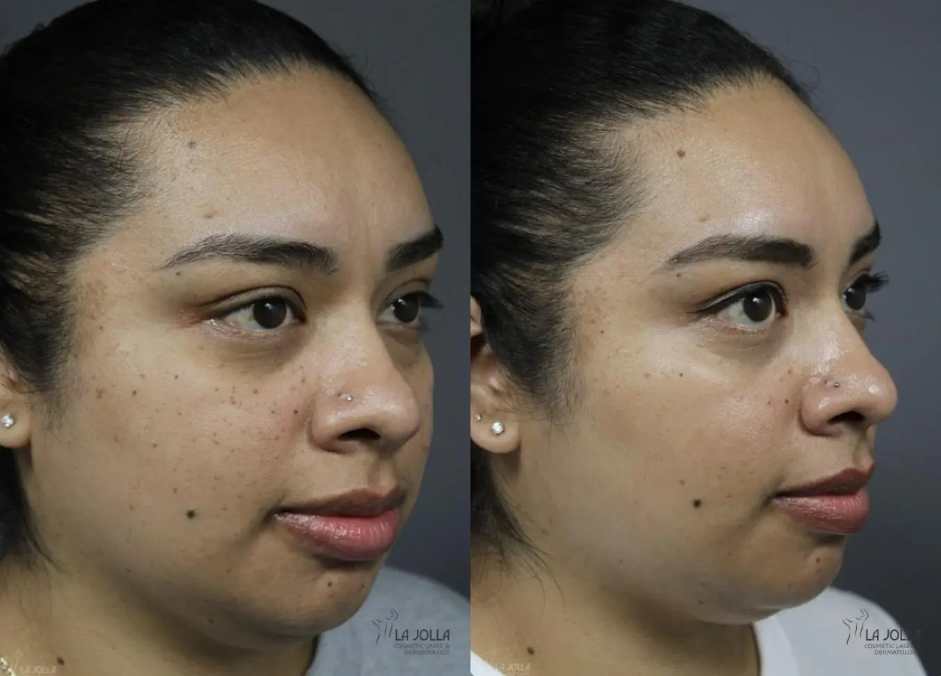Dermatosis Papulosa Nigra (DPN): Patient 1 - Before and After 3
