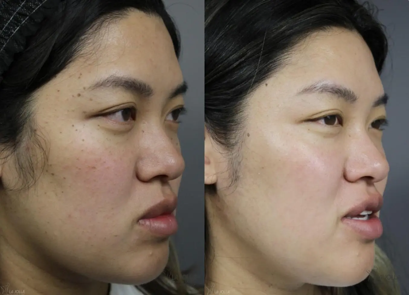 Dermatosis Papulosa Nigra (DPN): Patient 2 - Before and After 4