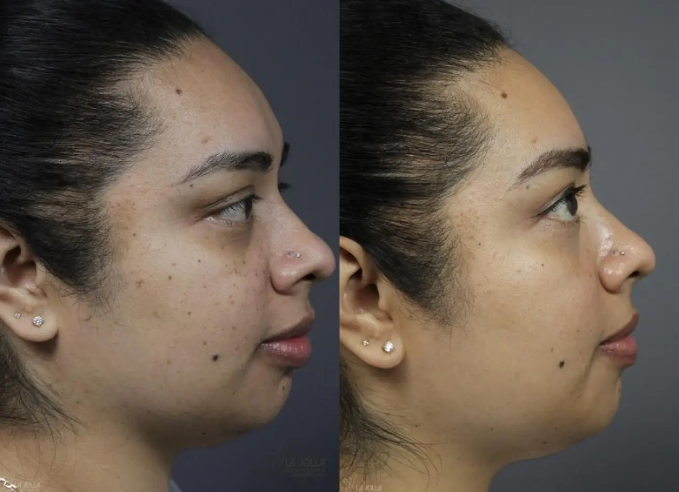 Dermatosis Papulosa Nigra (DPN): Patient 1 - Before and After 5