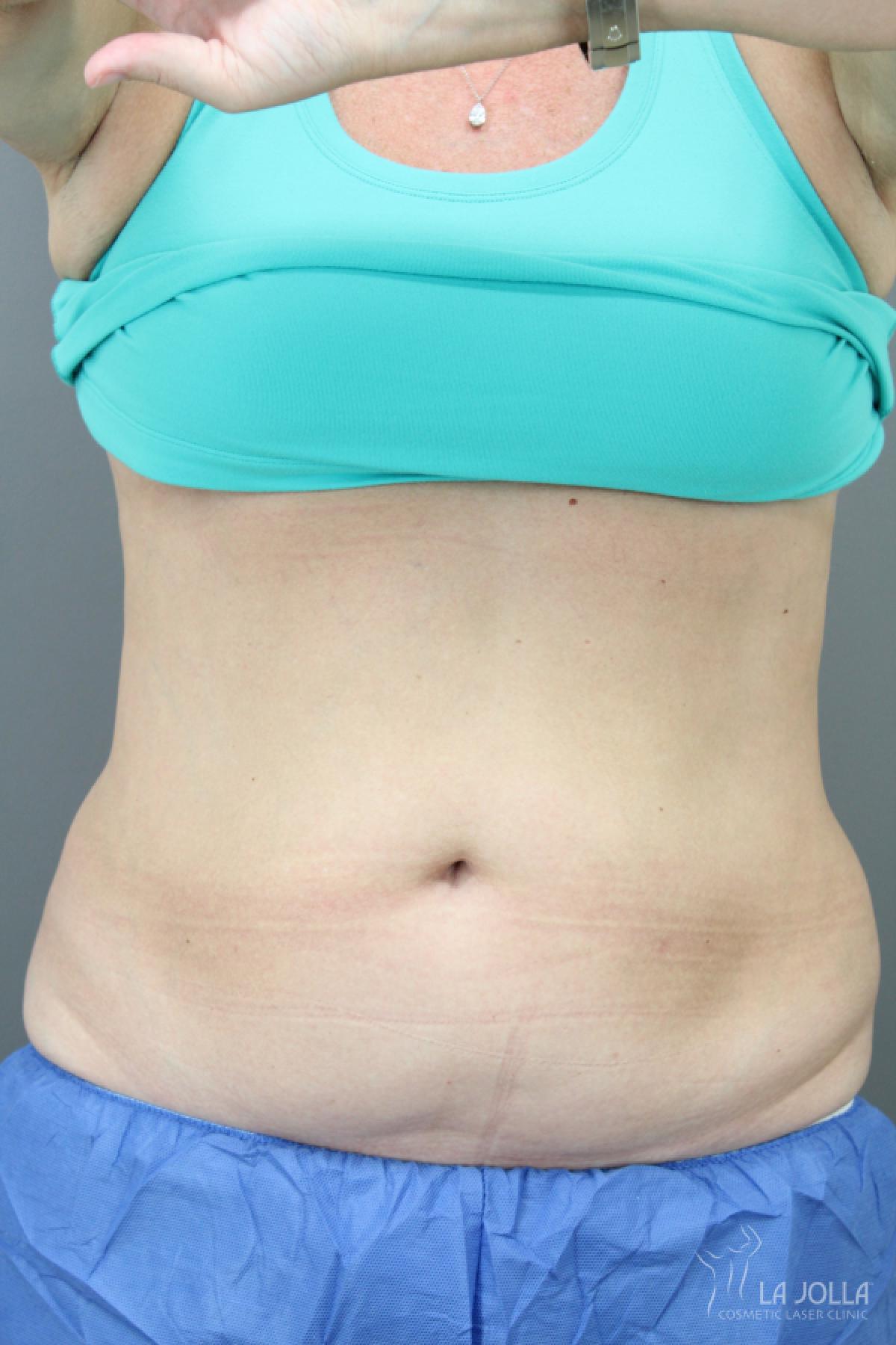 CoolSculpting®: Patient 4 - After  