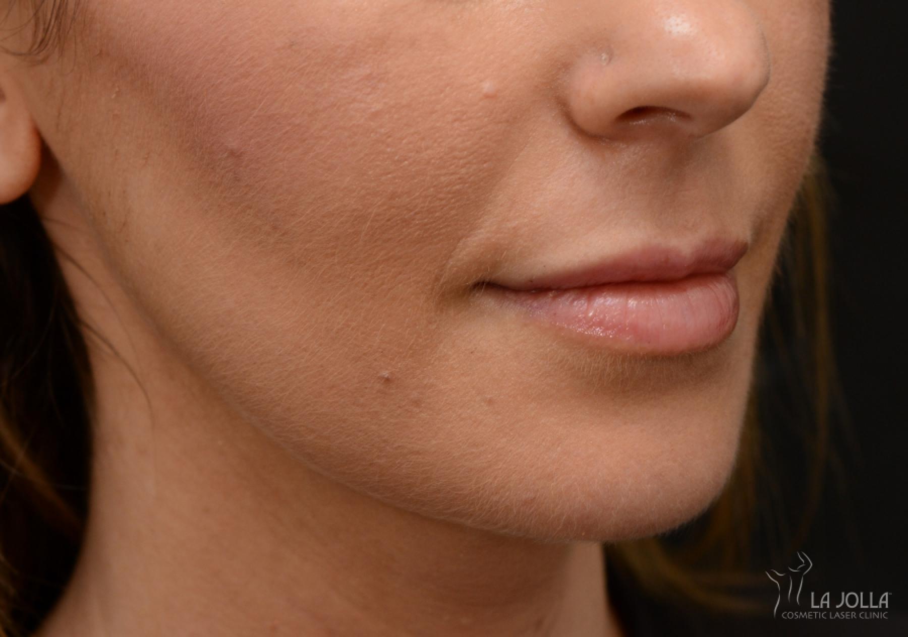 Lip Filler: Patient 11 - Before 1
