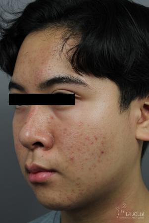 Chemical Peel: Patient 1 - Before and After 2