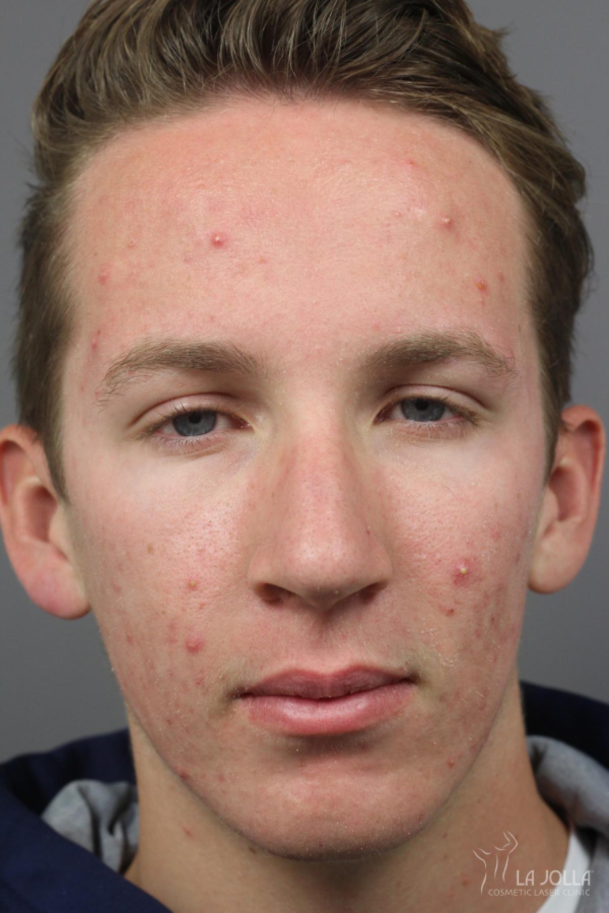 Acne Rejuvenation: Patient 9 - Before 