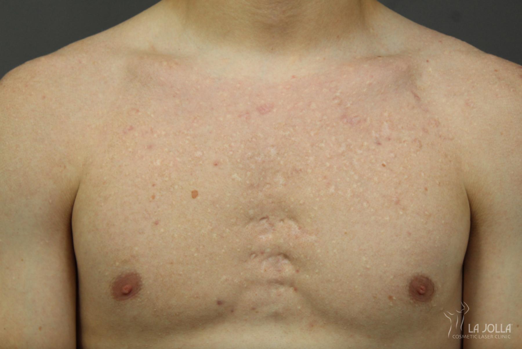Fraxel Scar Before and After -  After 1