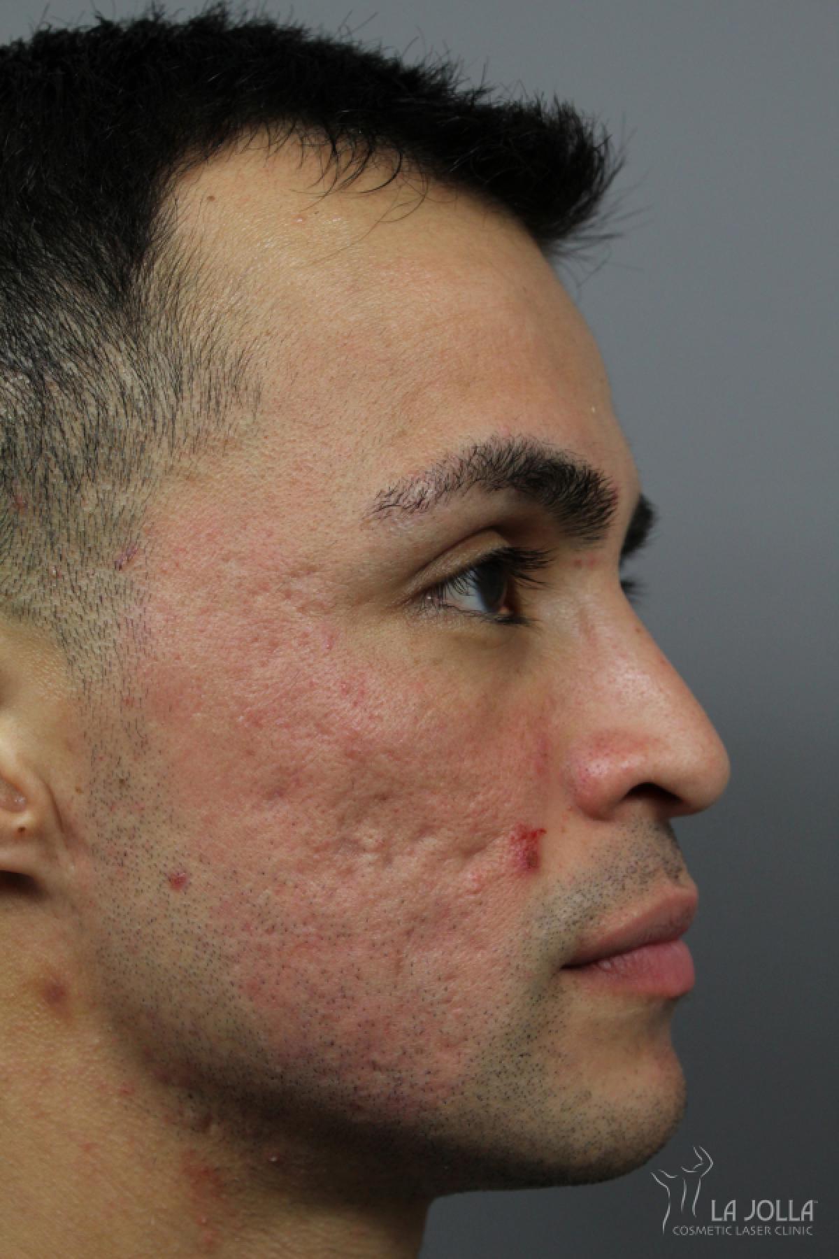 Acne Scars: Patient 4 - After 3