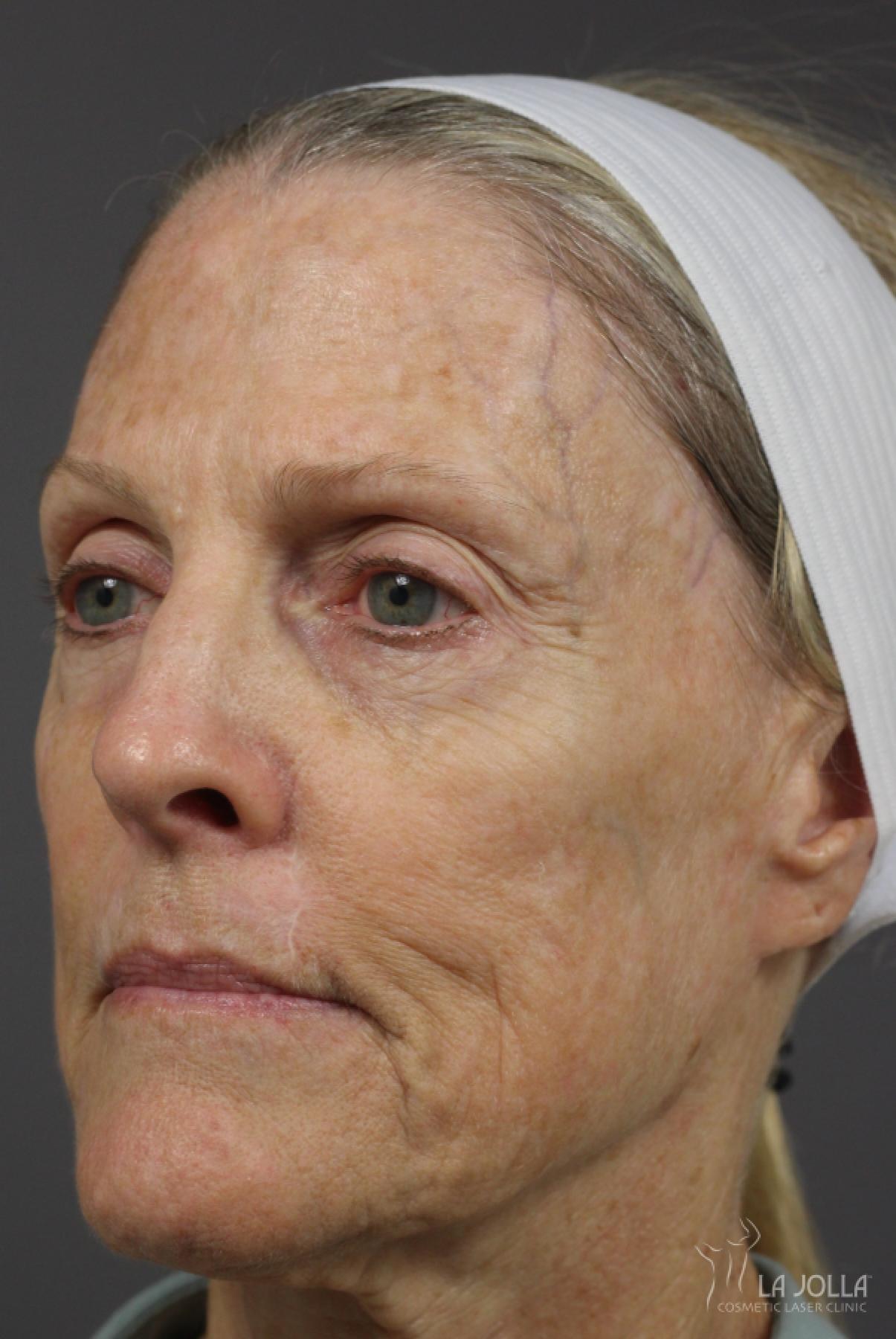 CO2 Laser: Patient 14 - Before and After 2