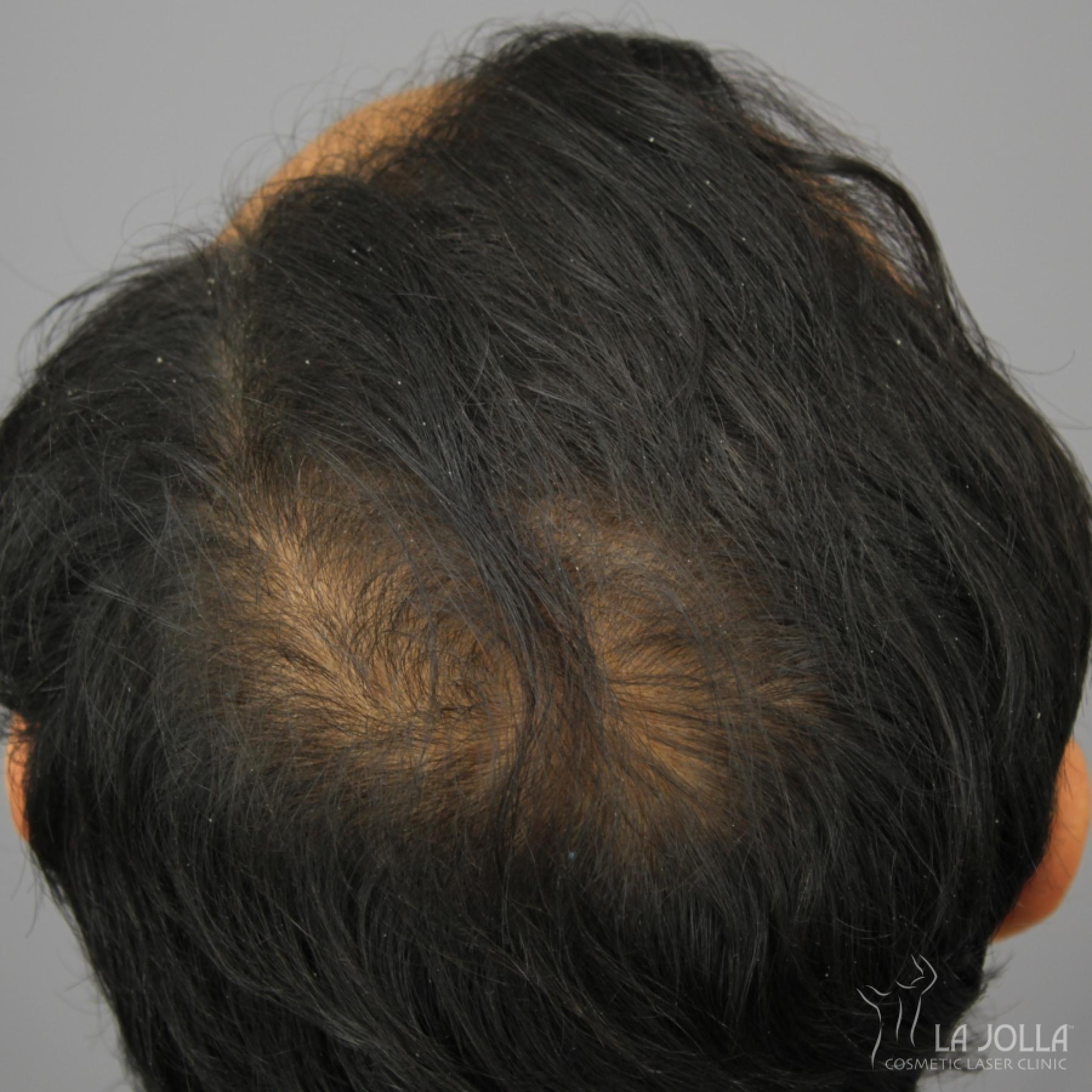 Hair Restoration: Patient 5 - After 1