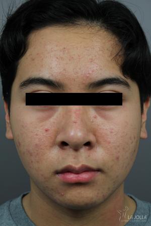 Fraxel®: Patient 3 - Before 