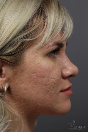 Juvéderm® XC: Patient 5 - After  