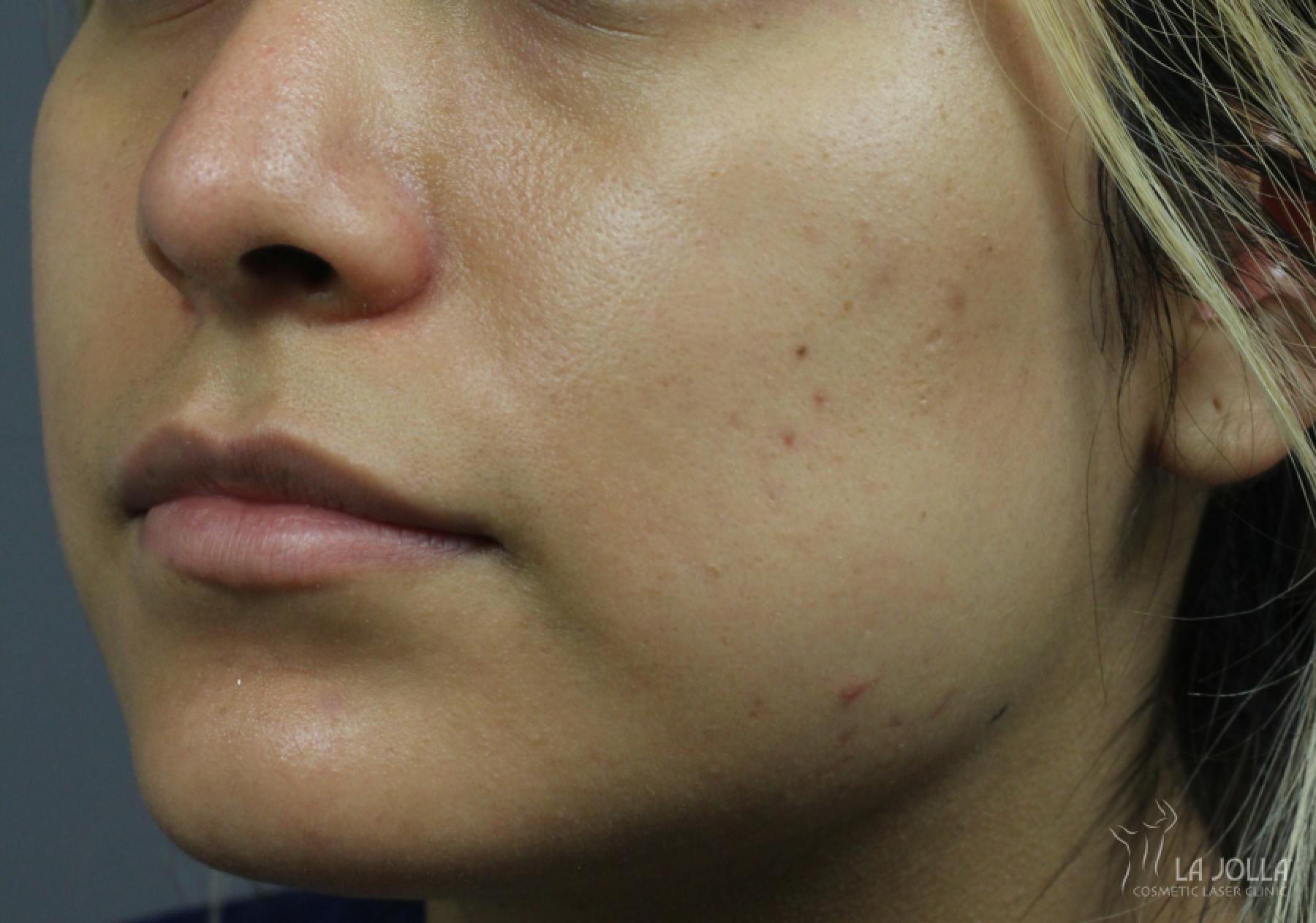 Lip Filler: Patient 12 - Before and After 3
