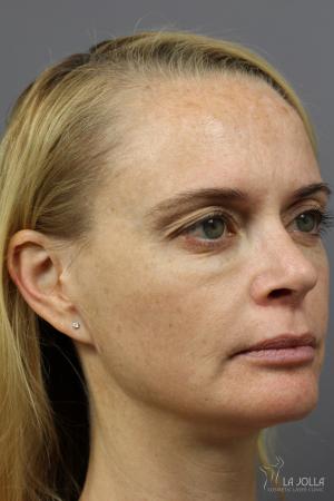 Sculptra®: Patient 10 - Before 