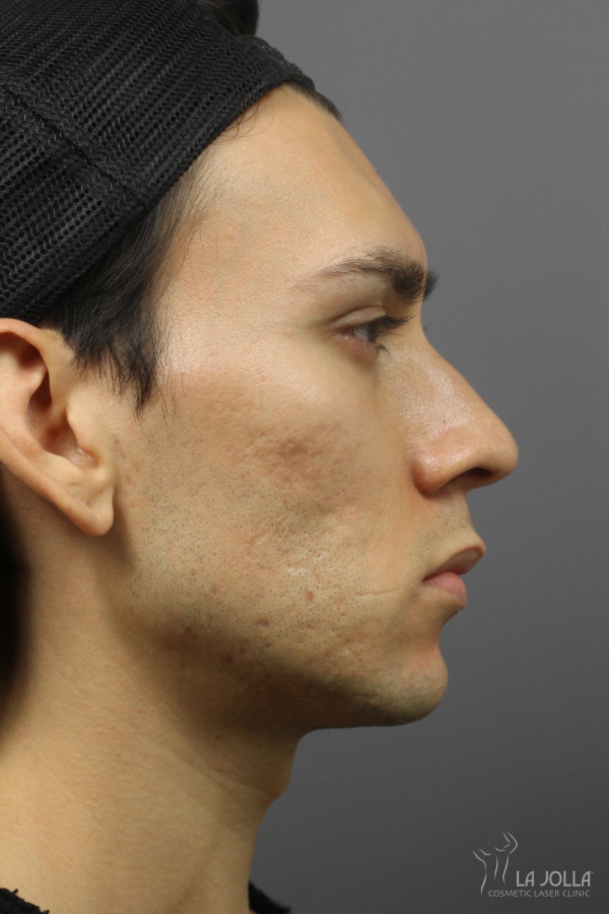 Acne Scars: Patient 7 - Before and After 2