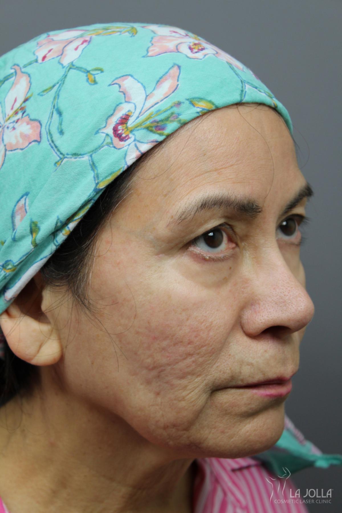 StarWalker® Laser: Patient 13 - Before 1