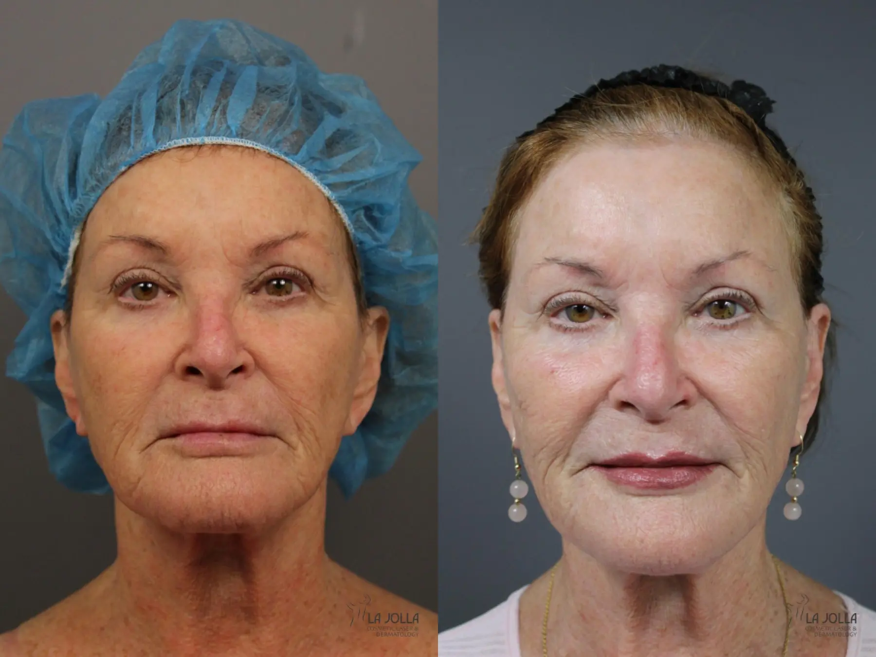 Fractional CO2: Patient 1 - Before and After