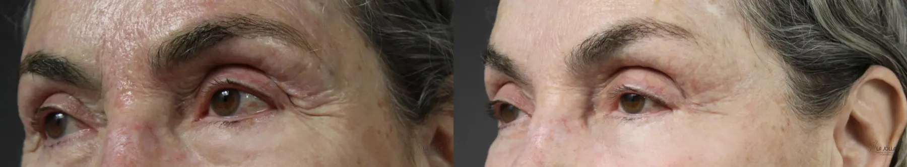 Fractional CO2: Patient 6 - Before and After 2