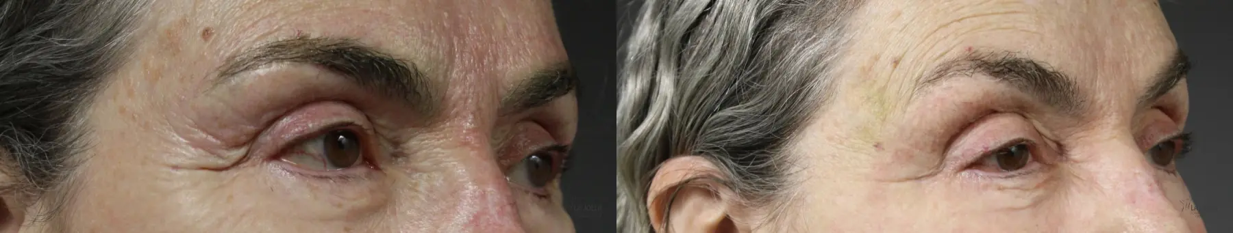 Fractional CO2: Patient 6 - Before and After 3