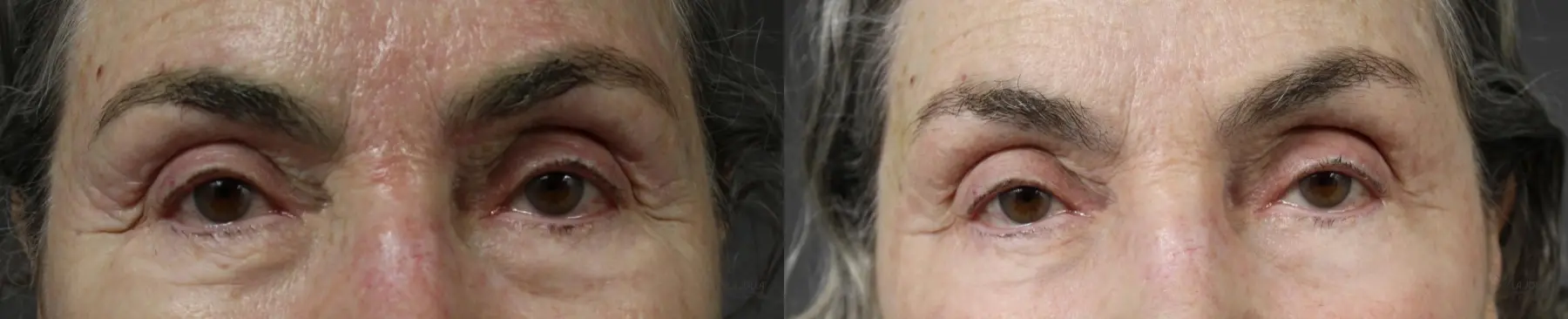 Fractional CO2: Patient 6 - Before and After