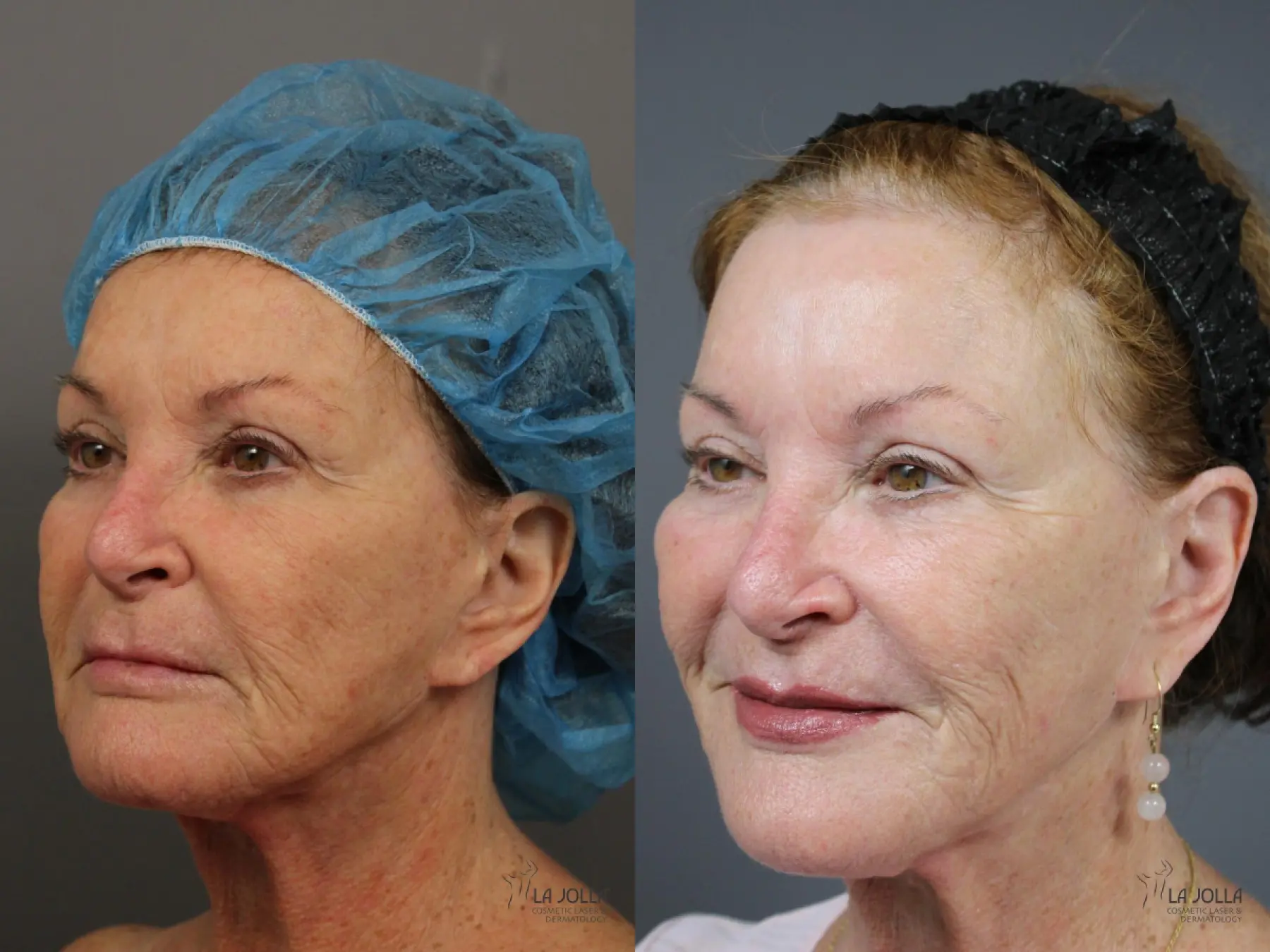 Fractional CO2: Patient 1 - Before and After 2