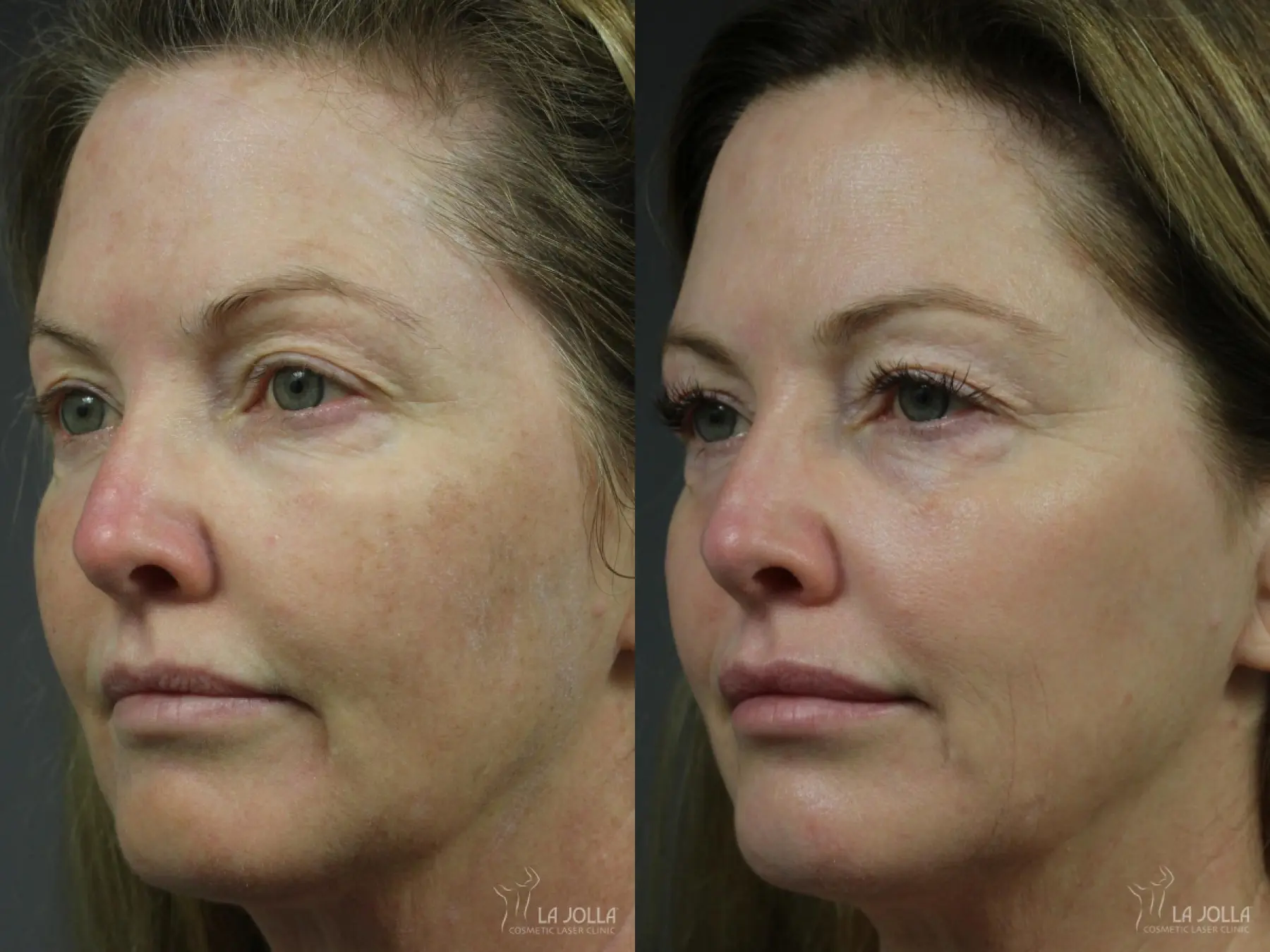 Fraxel®: Patient 9 - Before and After 1