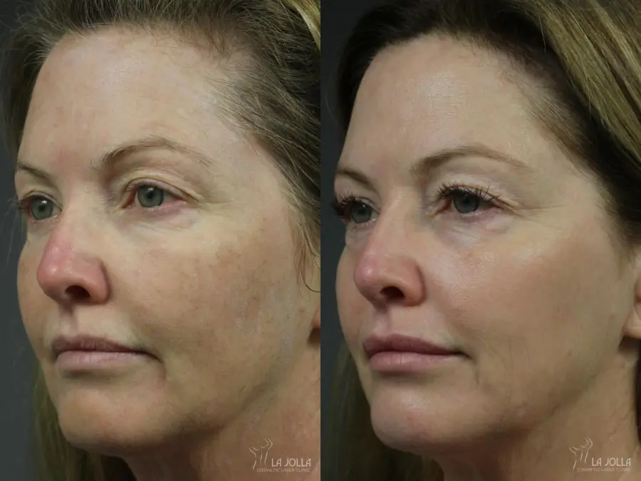 Fraxel®: Patient 5 - Before and After  