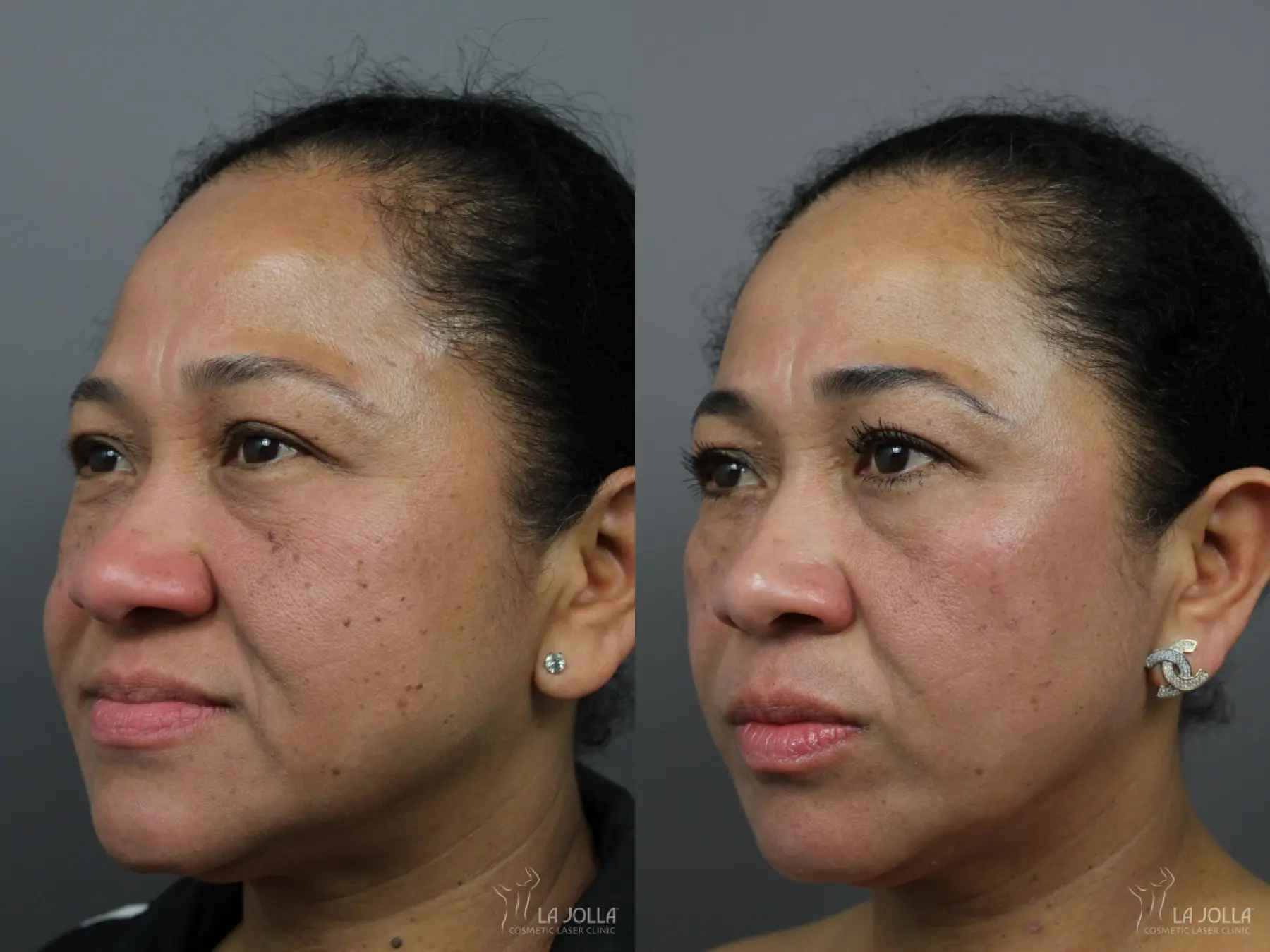 Fraxel®: Patient 9 - Before and After 3