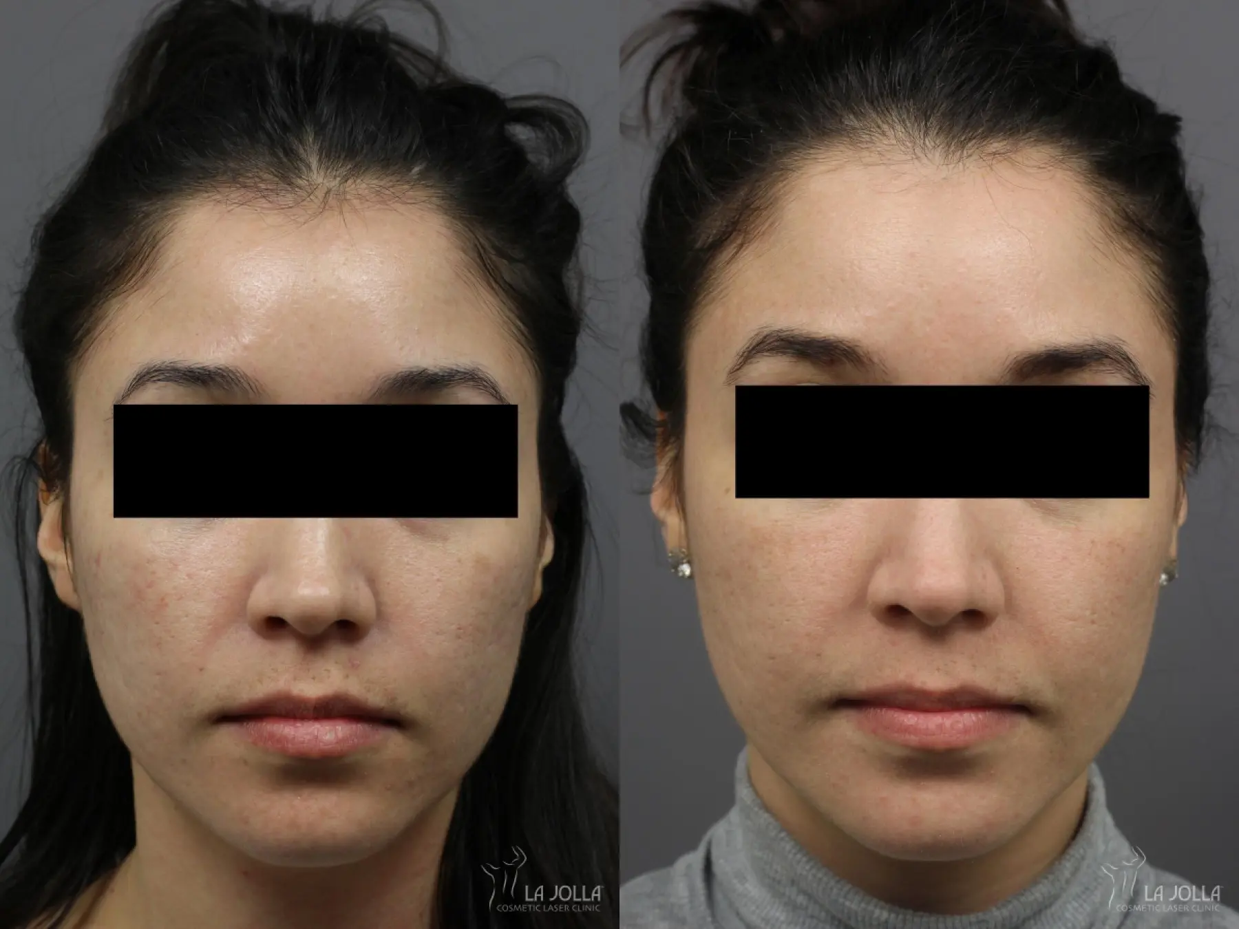 Fraxel®: Patient 9 - Before and After 2