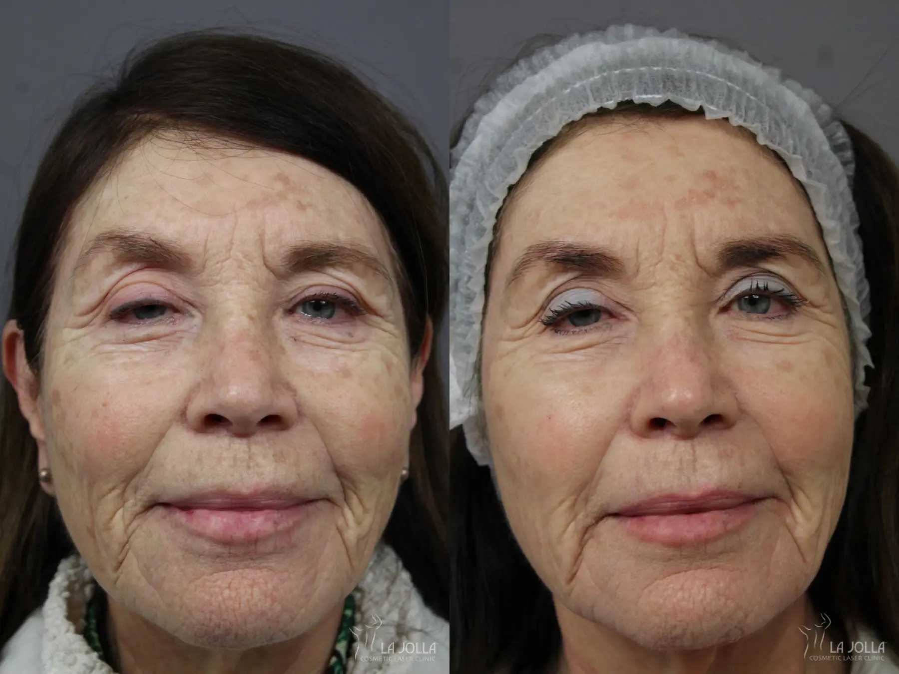 Fraxel®: Patient 1 - Before and After  