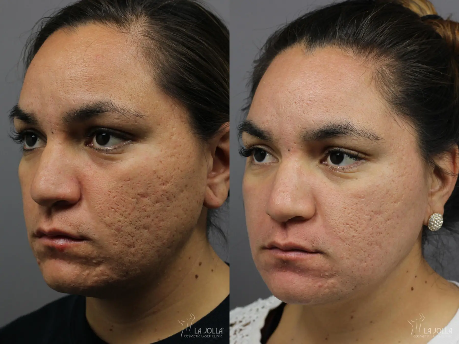 Fraxel®: Patient 9 - Before and After 1